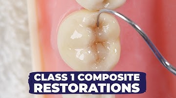 Composietrestauratie van klasse I: hoe het moet | Eenvoudige versus ingewikkelde techniek met Dr....