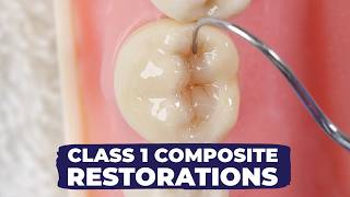 Class I Composite Restoration: How to | Simple Vs Fancy Technique with Dr Lincoln Harris