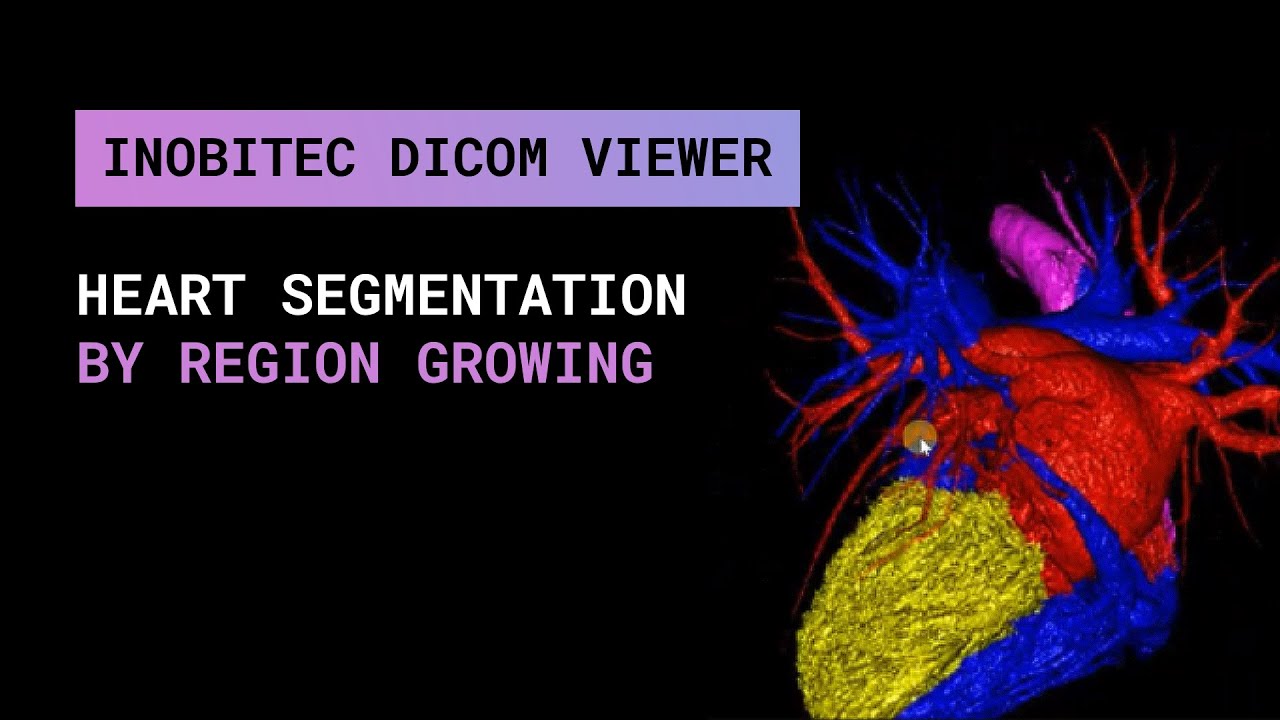 Heart segmentation by region growing in Inobitec DICOM Viewer Pro - YouTube