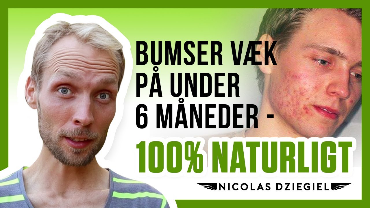 Bumser væk på under 6 måneder - 100% naturligt | Nicolas Dziegiel