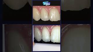 Desgaste incisal  #resinascompostas #restauracaodental #esteticadosorriso