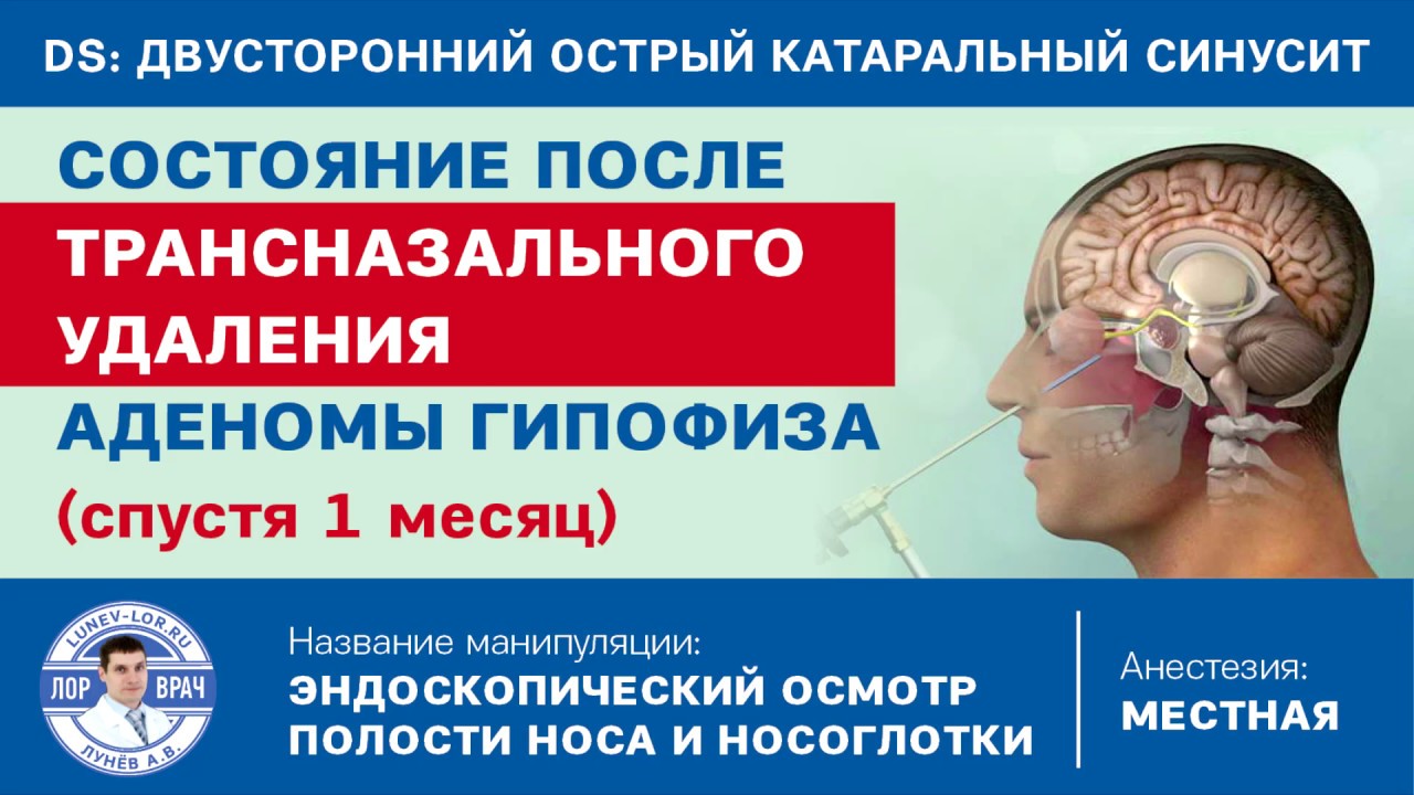 После операции аденомы гипофиза. Аденома гипофиза трансназально операция. Трансназальная резекция аденомы гипофиза. Трансназальная хирургия аденомы гипофиза. Трансназальное эндоскопическое удаление аденомы гипофиза.