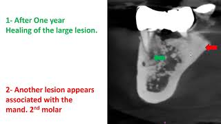Treatment of multiple periapical lesions non surgically 