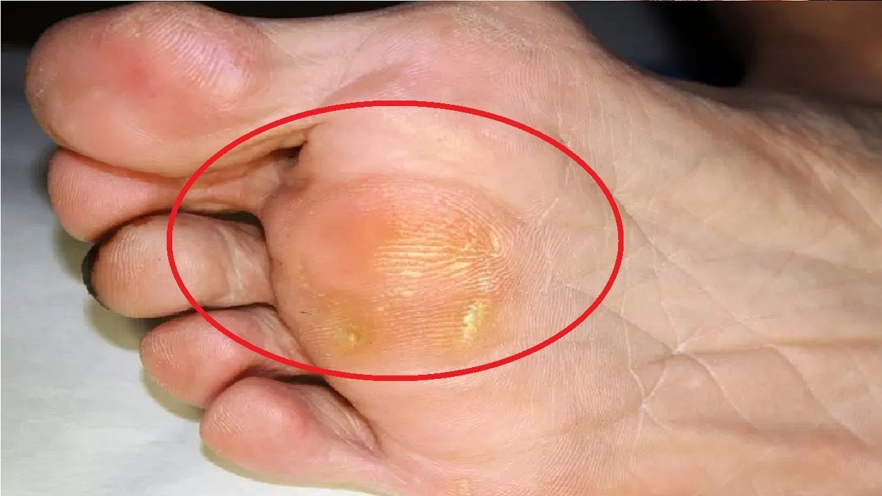 How To Get Rid Of Corns On Feet With Apple Cider Vinegar