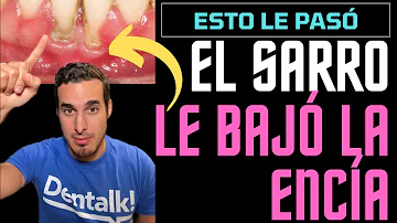 ¿Debe pasar el hilo dental por debajo de las encías?