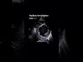 Echo Findings Pre & Post CABG?