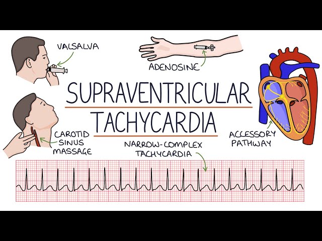 Understanding Supraventricular Tachycardia (SVT) class=