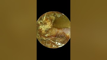 YEARS Of Hearing Loss RESOLVED After This SATISFYING Earwax Removal (MUST WATCH Video)
