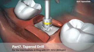 DIO SM SURGICAL PROCEDURE ANIMATION