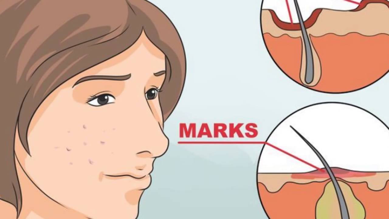 How to Remove Pimple Black Marks in One Week OR How to Reduce Pimples