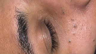 Глубокое очищение лица [ASMR] для удаления прыщей и черных точек | Приятный уход