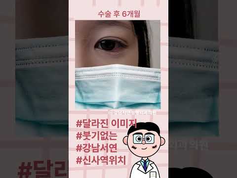 절개쌍꺼풀 앞트임으로 이미지 완전 변신