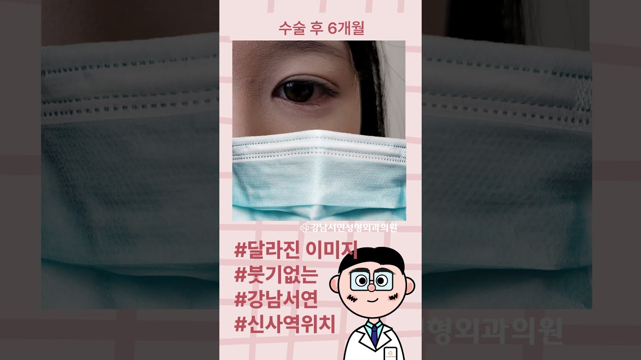 [Ганнам Соён гоо сайхны мэс засал] Зүсэлттэй давхар зовхи, нүдний дотор булан нээх мэс заслаар дүр төрхөө бүрэн өөрчил.