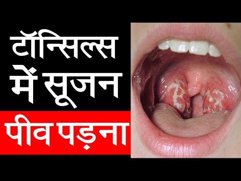 वीडियो: क्या मुझे पेरिटोनसिलर फोड़ा के लिए एर के पास जाना चाहिए?