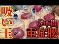 【吸い玉　整体】5年つらい腰痛　瘀血で背中がヤバい　長い鍼でガッツリ治療です　こんなに変わる？【銀座　横浜　鍼灸治療】