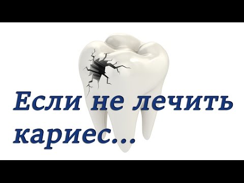 Кариес зубов. Пульпит, симптомы и лечение. Основы эндодонтии. Терапевтическая стоматология