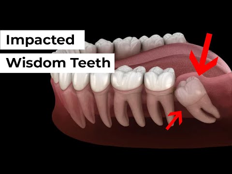 Wideo: Czy powinienem usunąć zatrzymane zęby mądrości?