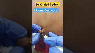 massive skin tag removal shorts cystremoval skincare pimplepopper Dr khaled sadek 