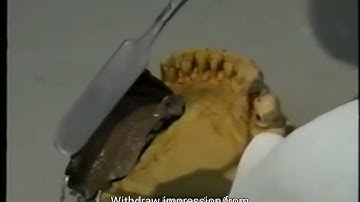 Altered Cast Impression Technique edited