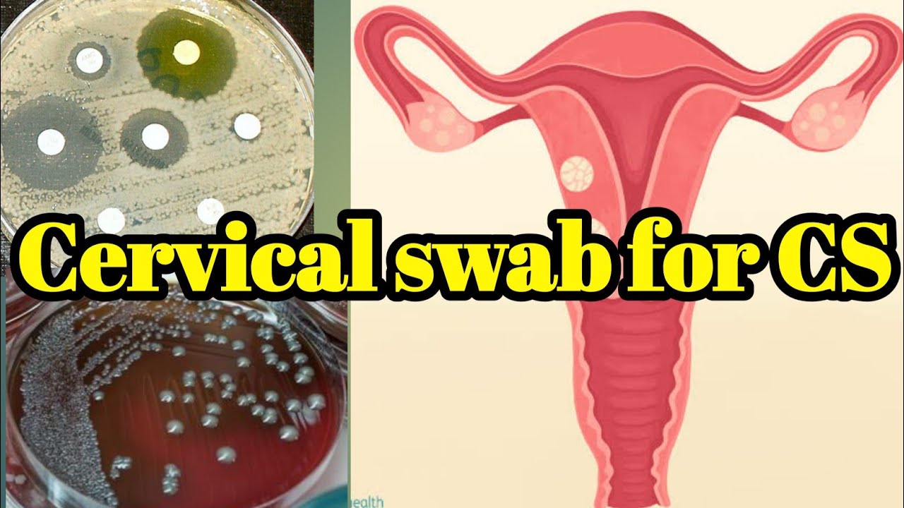 cervical swab for Culture and Sensitivity (C/S) test