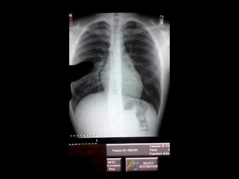 Video: Radiografi dada