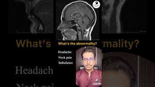 What’s the abnormality? #neurology #radiology #neetpg