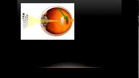 Cataracts, Glaucoma and Macular Degeneration (Video 6)