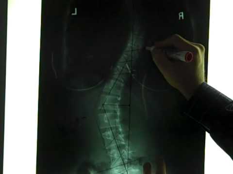 What Scoliosis Icd X