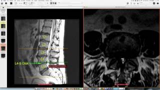 MRI scan of the lumbar spine