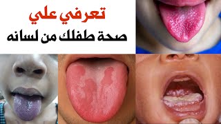 ٦ علامات علي لسان طفلك لا تغفلي عنها أبدا العلامة الخامسة تهدد حياة طفلك 😱 | صحة طفلك من لسانه