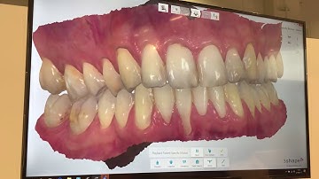 Jaw tracking device - 3shape TRIOS Patient Specific Motion