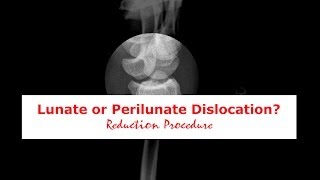 Lunate or Perilunate Dislocation?