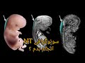سونوگرافی NT NB سونوگرافی آنومالی اسکن چطپر انجام لازم هستش سونو انجام بدم سونوگرافی NT NB سونوگرافی آنومالی اسکن چطپر انجام لازم هستش سونو انجام بدم