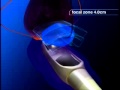 High Intensity Focused Ultrasound (HIFU) - California