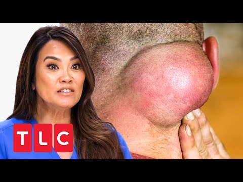 Ein Tumor im Nacken! | Dr. Pimple Popper | TLC Deutschland