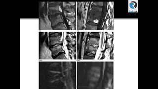 Lumbar Spine MRI Part 13: Discitis and DWI