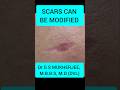 Scar treatment on face #drgsmukherjee #co2laser #dermatologist #laserclinic