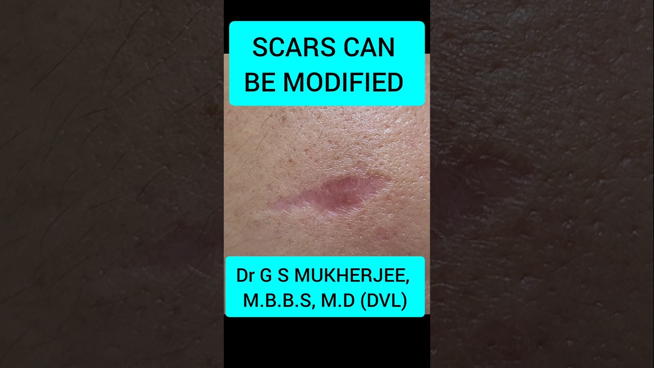 Scar treatment on face #drgsmukherjee #co2laser #dermatologist #laserclinic
