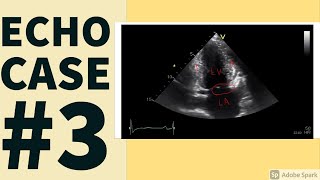 ECHO CASES| CASE 3|ECHOCARDIOGRAPHY| EDUCATIONAL VIDEO