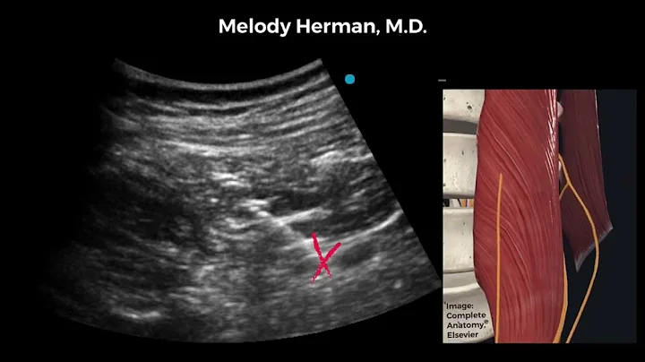 Bilateral anterior quadratus lumborum blocks from one lateral decubitus position