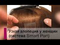 Система волос Smart Part при узкой алопеции у женщин