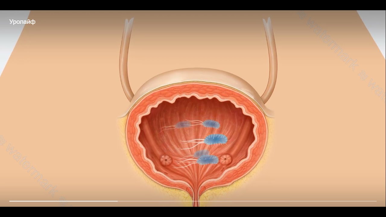 Уролайф Инстилляции Мочевого Пузыря Цена