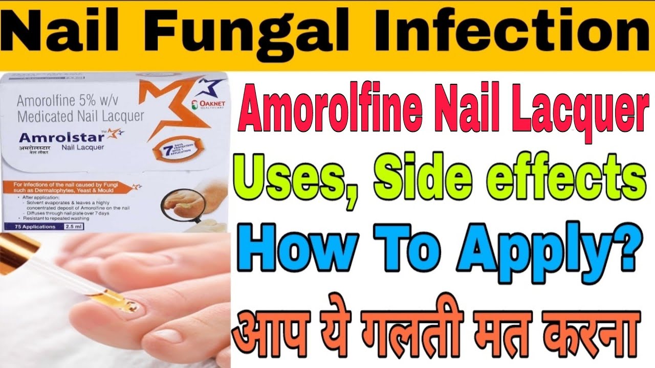 💅 How to apply antifungal nail lacquer to nail fungus? | by Dermatologist  - YouTube