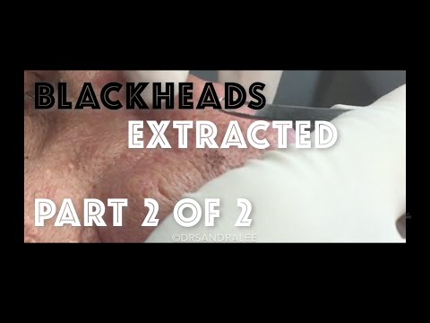 Extracting Blackheads On The Face And Nose - Part 2 Of 2