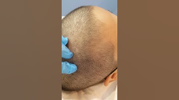 Healed 1st session Density Restoration SMP + fresh 2nd session few dots by El Truchan