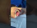 ពត់ធ្មេញ -fix braces #dentist #dentalcare #shorts