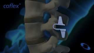 coflex® Non-Fusion Implant in Flexion and Extension | Paradigm Spine