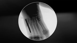 Minimally Invasive Correction of a Type 3 Tailor’s Bunion Using a Beveled Screw