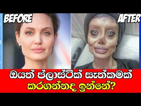 Plastic Surgery Before and After | All about plastic surgery in sinhala - ප්ලාස්ටික් සැත්කම්