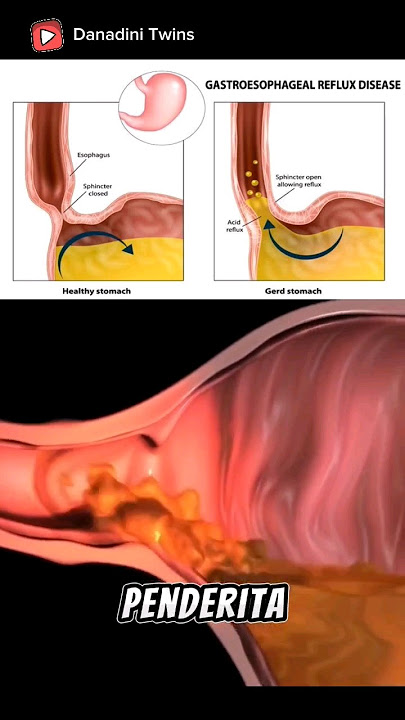 Gambaran penyakit GERD  #gerd #esophageal #kerongkongan #kesehatan #short #biologi #medis
